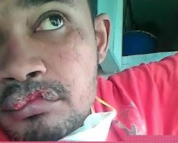 Recluso le arranca parte del labio a otro de una mordida en cárcel de Montecristi 3 Recluso le arranca parte del labio a otro de una mordida en cárcel de Montecristi