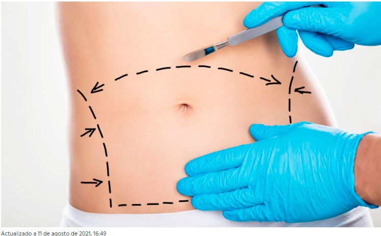 Abdominoplastia: cómo se hace la cirugía de reducción de abdomen