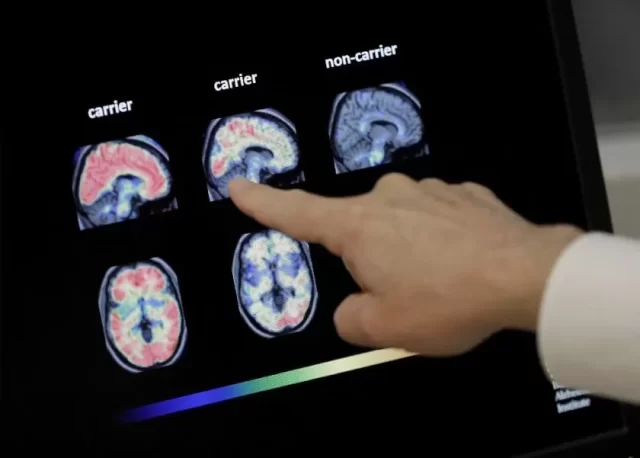 EEUU autoriza nuevo tratamiento para la enfermedad de Alzheimer 1 Alzheimer e1673049508829
