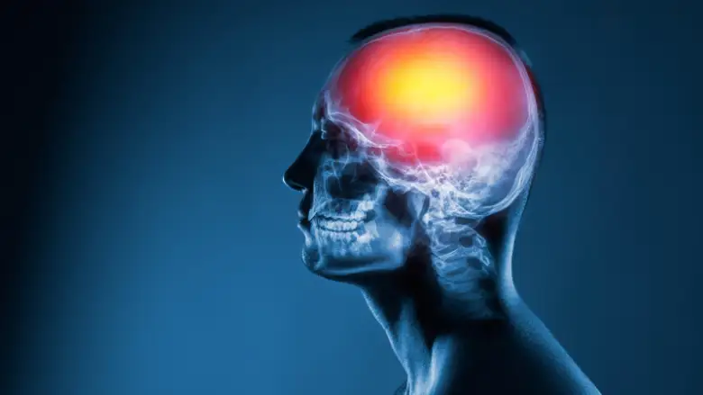 ¿Por qué aumentan los accidentes cerebrovasculares entre los jóvenes? 1 Accidentes cerebrovasculares ACV FE