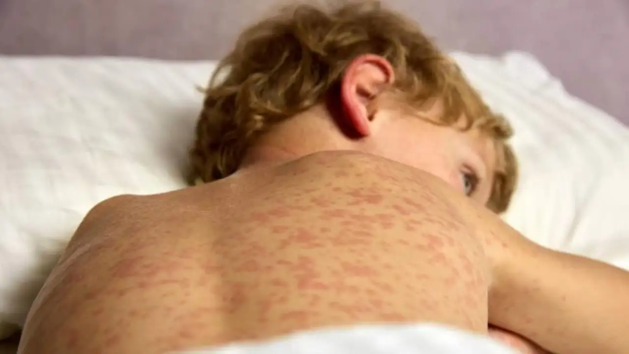 Sarampion menores edad FE