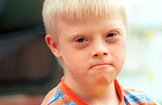 La prueba médica que podría acabar con el síndrome de Down (y por qué algunos no quieren que eso ocurra)