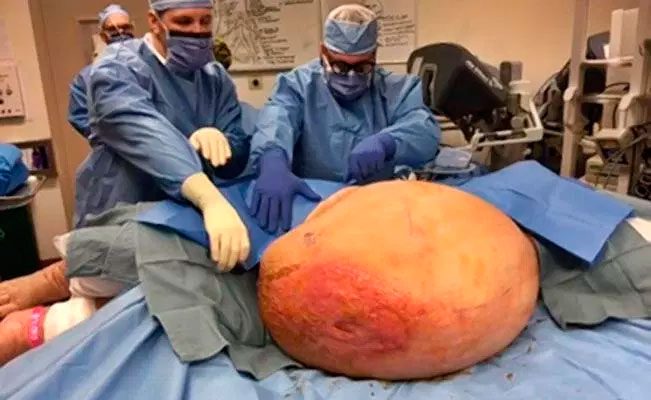 Médicos extraen un tumor de más de 60 kilos a una mujer