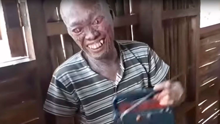 Lo consideran un demonio por sufrir una rara enfermedad de la piel (+video)