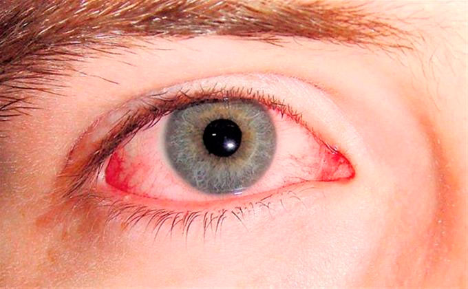 Ojo rojo conjuntivitis FE