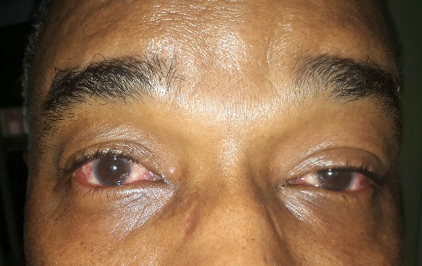 La República Dominicana reporta más de 93.000 casos de conjuntivitis este año 1 CONJUNTIVITIS