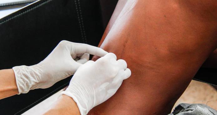 La lepra es motivo de mucha consulta dermatológica