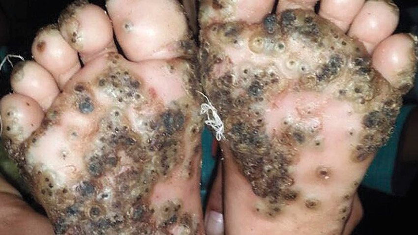 La niña de 10 años con pulgas incrustadas en los pies 1 Nina pulgas pies FE