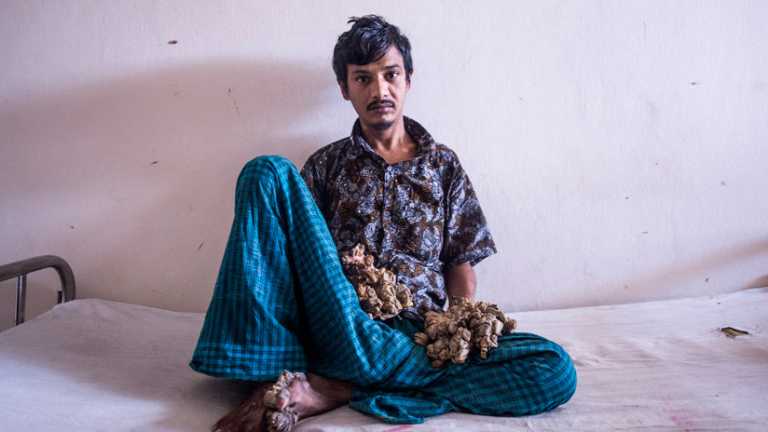 «No puedo soportar más el dolor»: El ‘hombre árbol’ de Bangladés pide que le amputen las manos