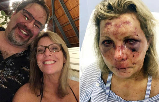 Esposo de turista agredida en hotel rechaza versión de las autoridades dominicanas