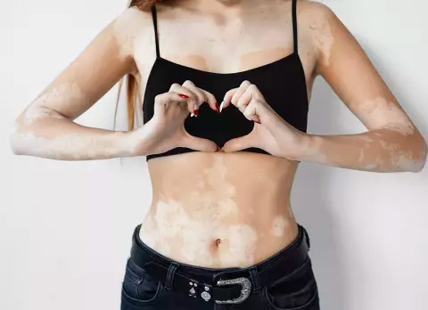 Mujer Vitiligo FE