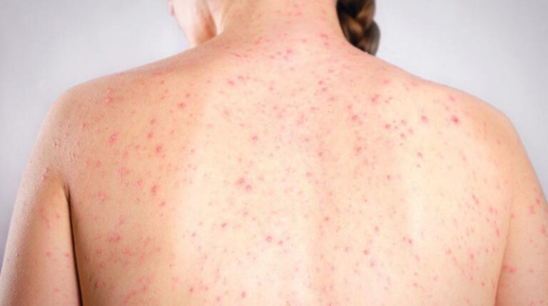 Sarampión y dengue son alta amenaza para el país este año