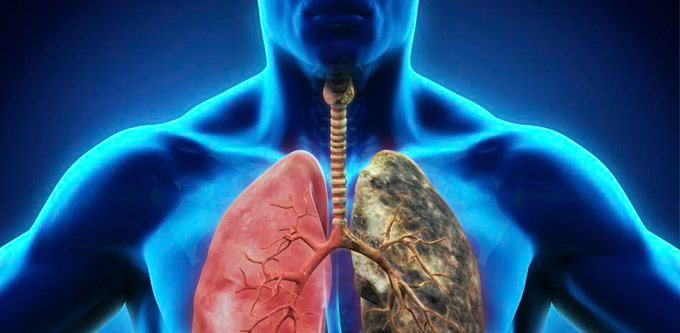 En un año, más de 11 mil personas fueron diagnosticadas con cáncer de mama en RD 6 Imagen ilustrativa del cáncer de Pulmón. FOTO EXTERNA
